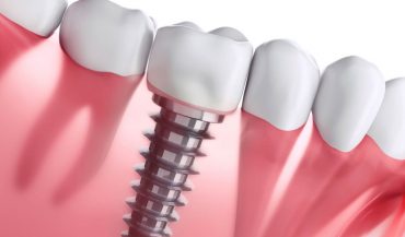 7 Clear Benefits of Opting for Dental Implant