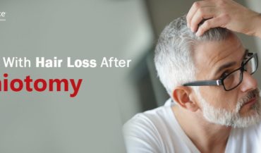 Dealing With Hair Loss After Craniotomy