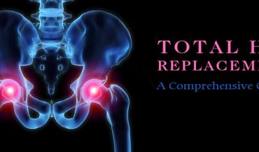 Hip Replacement Surgery Cost Guide – Procedure Cost Breakdown, Tips To Select Hospital
