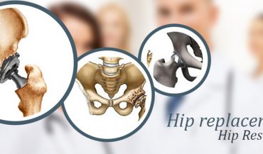 Hip Resurfacing vs Hip Replacement: Know The Difference