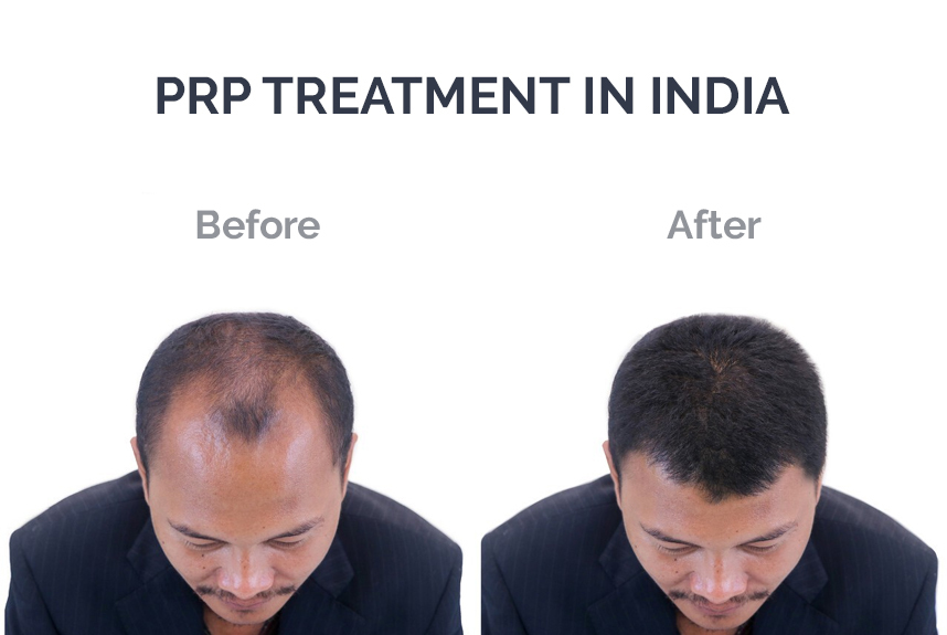 Hair Transplantation Cost in India | Best Hospitals for Hair Transplant in  India