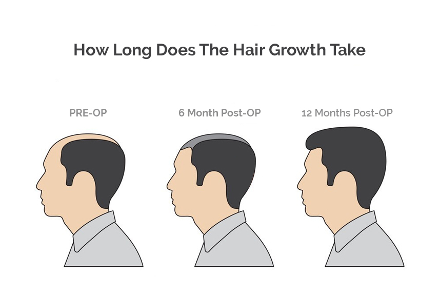 How Long Does The Hair Growth Take?