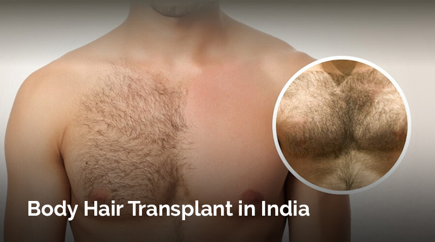 Body Hair Transplant In India