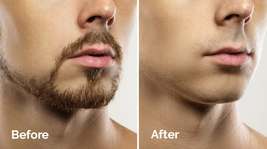 Moustache Hair Transplant in India
