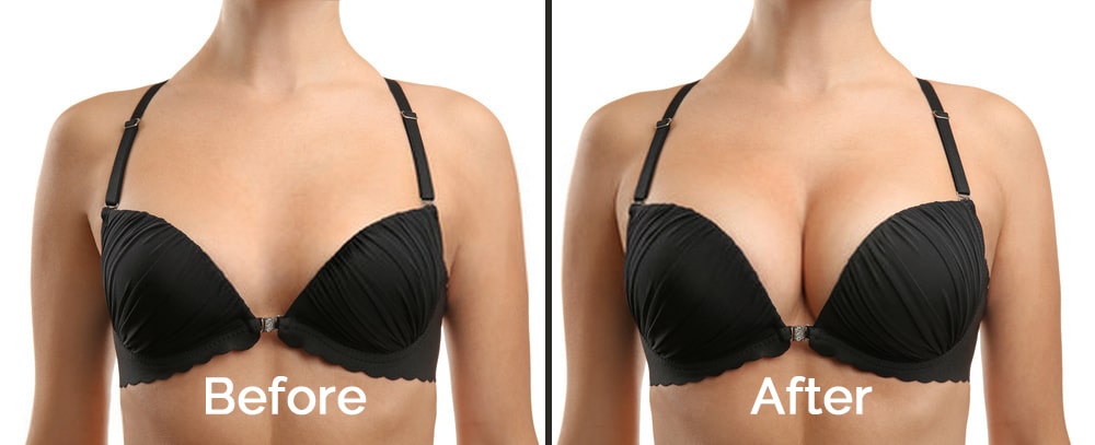 Breast Lift and Breast Augmentation are one of the most popular cosmetic procedures in South Korea.