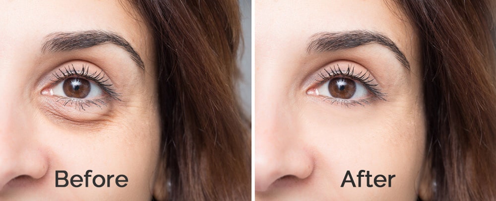 Blepharoplasty Surgery Before and After Images. Blepharoplasty Surgery is one of the most popular plastic procedures in South Korea. Know more about the best clinics, surgeons, and Clinics for Blepharoplasty in South Korea.