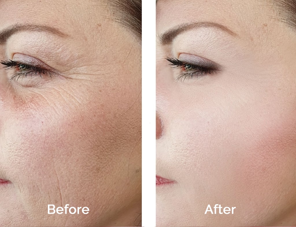 The following before and after images helps illustrate the results of Blepharoplasty Procedure. Double Eyelid Surgery in South Korea is one of the most sought after procedures in South Korea. Know more about its cost, clinics, and top plastic surgeons