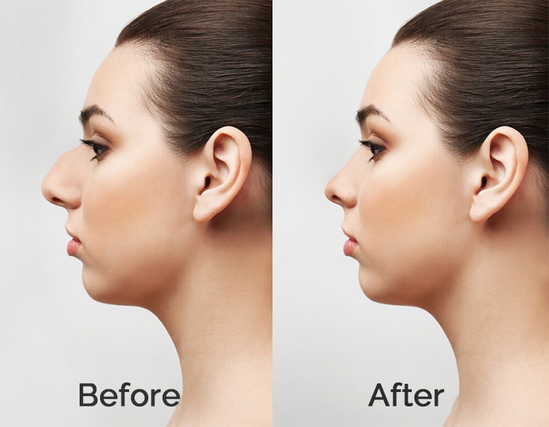 Before and After Images of Rhinoplasty Surgery for one of the top clinics in South Korea. FInd out about the best clinics, surgeons, and cost of Rhinoplasty in South Korea.