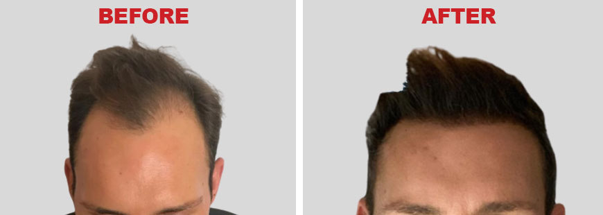 DHI Hair Transplant - Before and After