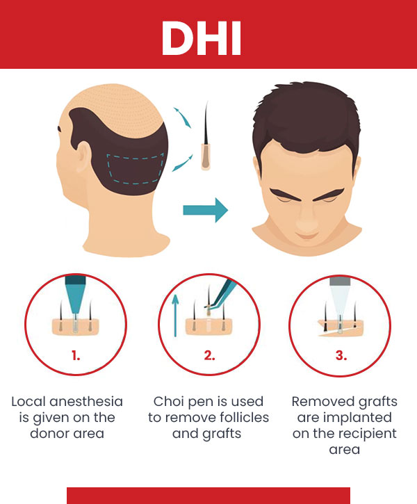 Steps of DHI Hair Transplant - Infographics