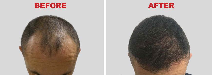 FUE Hair Transplant - Before and After