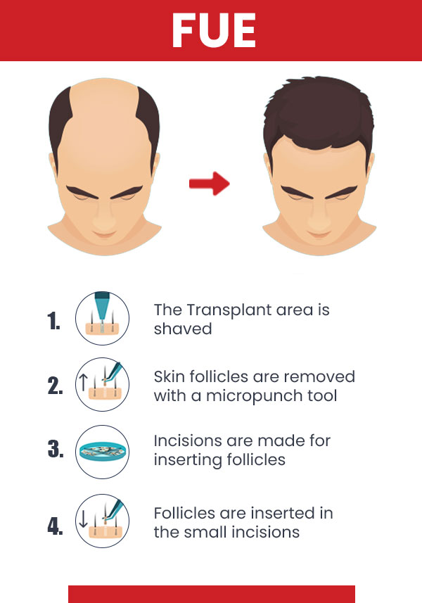 Steps of FUE Hair Transplant - Infographics