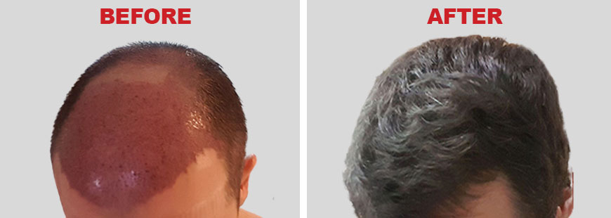 FUT Hair Transplant - Before and After