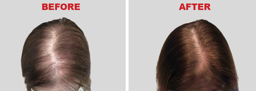 PRP Hair Treatment - Before and After