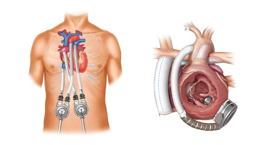 Insertion of a ventricular assist device (VAD) or total artificial heart (TAH) or LVAD