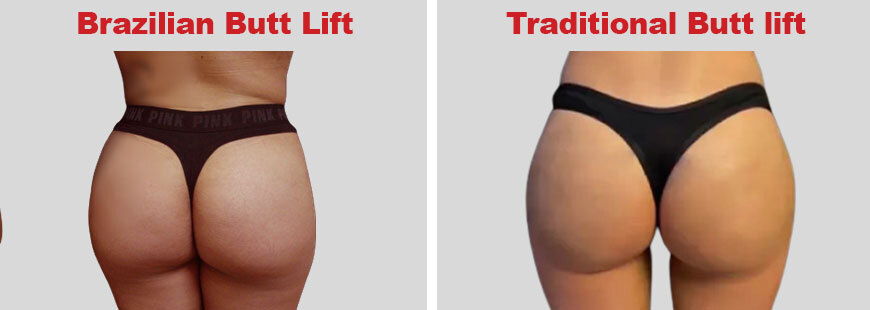 Brazilian Butt Lift vs Traditional Butt lift