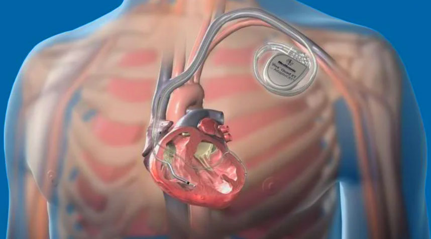 Insertion of a Pacemaker or an Implantable Cardioverter-Defibrillator (ICD)