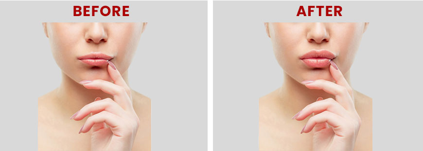 Needleless Treatments Before and After