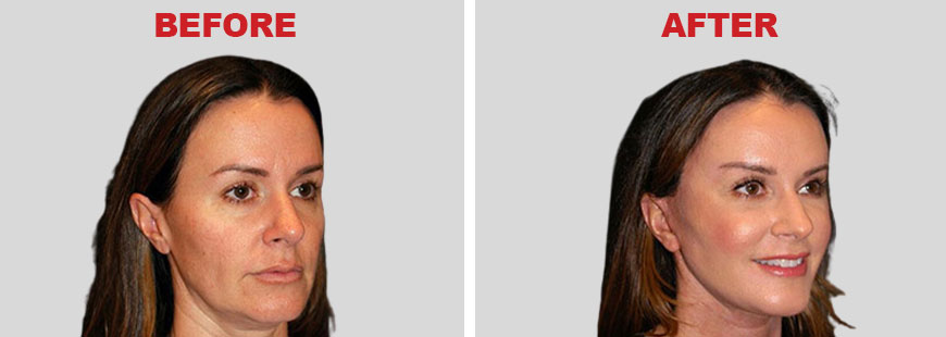 Facelift Surgery Before and After
