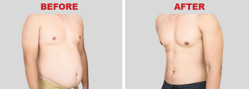 Liposuction surgery Before and After