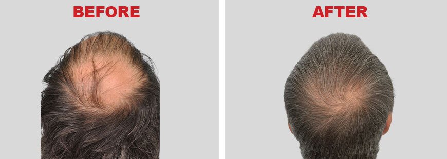 Hair Transplants Before and After