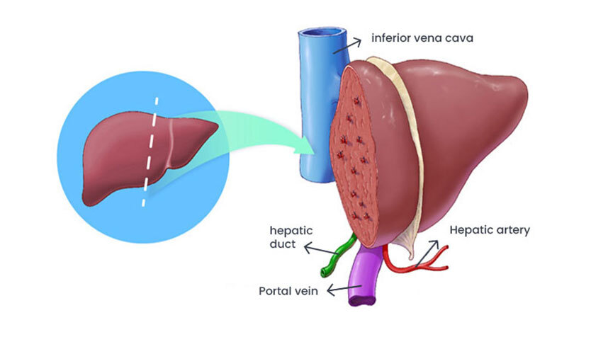 Treatment Options for Liver Disease - Liver Transplant