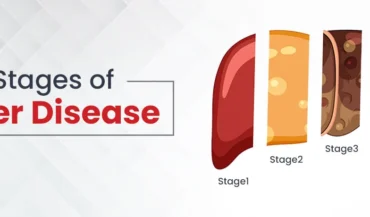 Quelles sont les quatre principales étapes de la maladie du foie