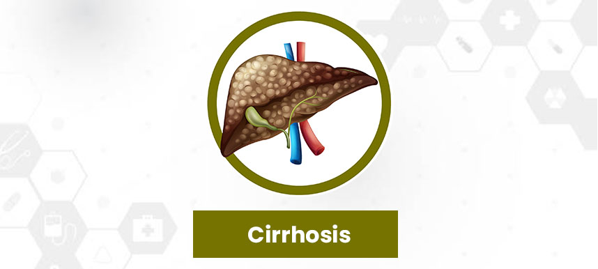 Stages of Liver Disease - Cirrhosis