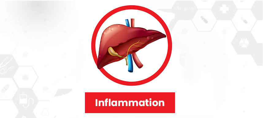 Stages of Liver Disease - Inflammation