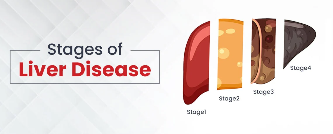 What Are The Four Major Stages of Liver Disease