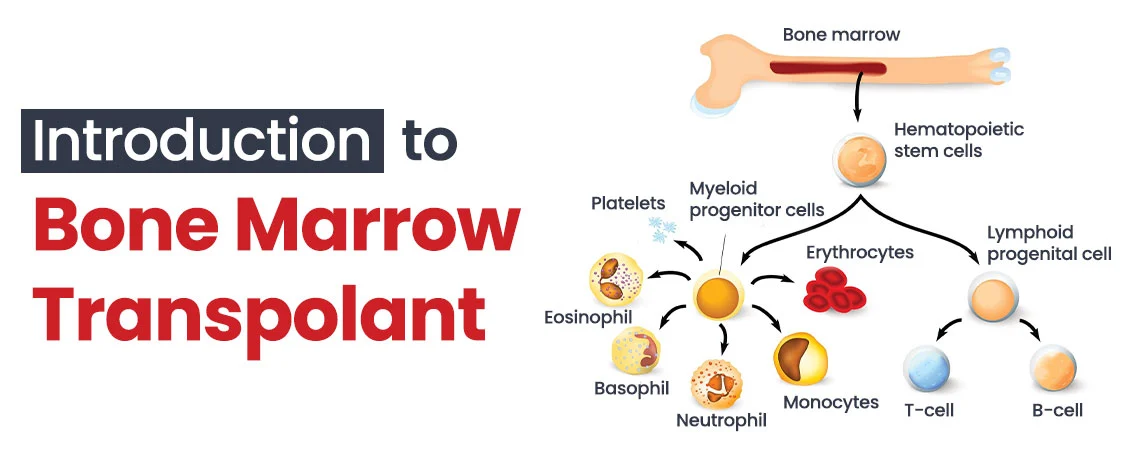 All You Need to Know About Bone Marrow Transplant